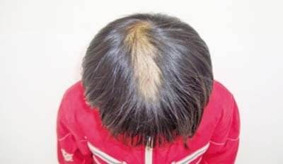 遗传性脱发对于头发怎么样