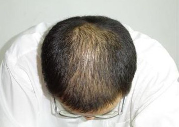 什么是体质性脱发？
