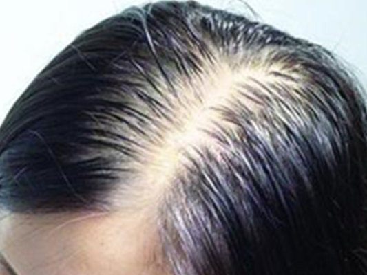 如果得了脂溢性脱发该怎么办呢？