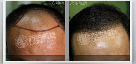 遗传性脱发怎么办？遗传性脱发能治好吗