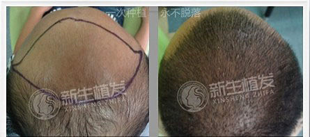 头发脱发又有油怎么办