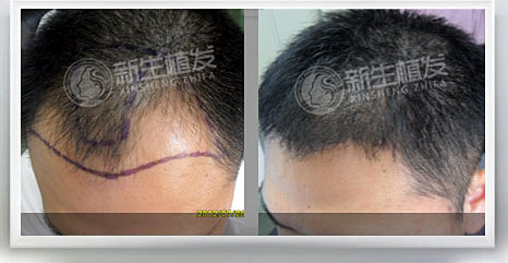 脱发什么时候稳定