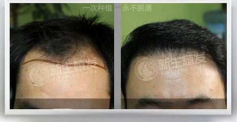 什么时候脱发才稳定