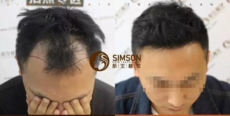 头发稀疏怎么办？加密就好啦！