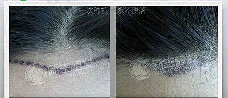 为什么会导致头顶头发稀少？
