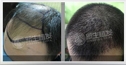 为什么会脱发？可以治疗么？