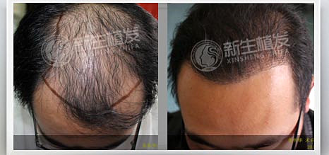 脱发能全部治好吗
