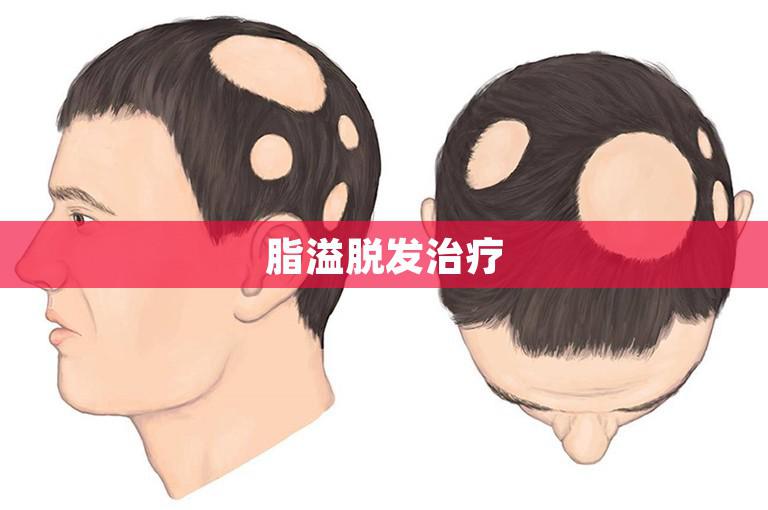 脂溢脱发治疗