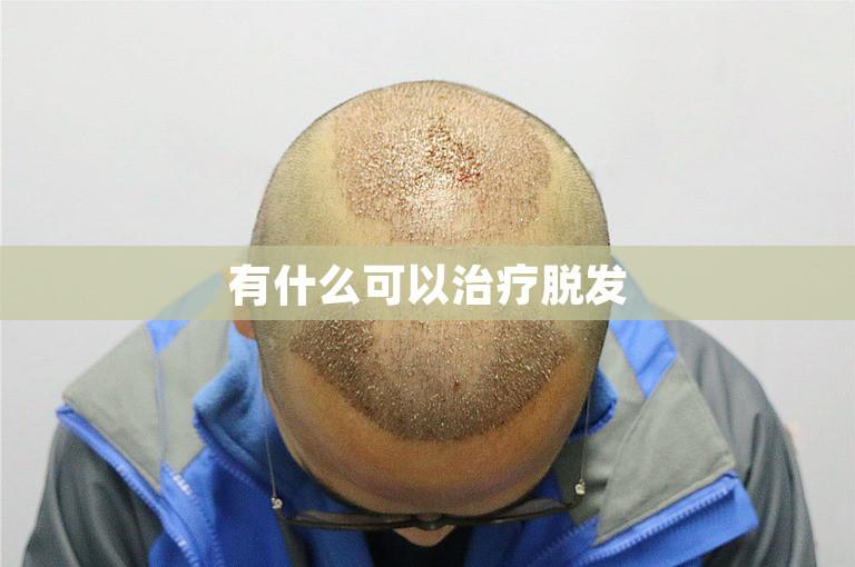 有什么可以治疗脱发