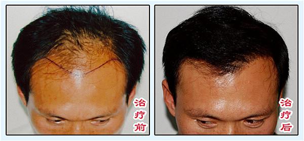 脱发治疗哪种方法好
