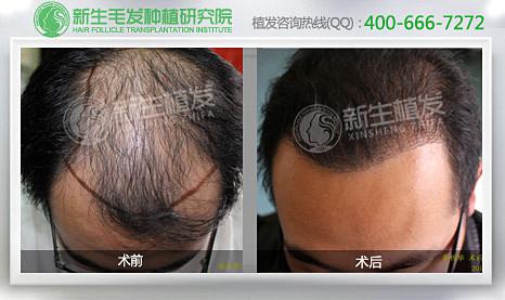 如何正确治疗脂溢性脱发