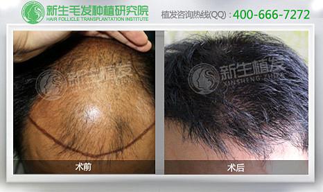 怎样防止脱发掉发呢
