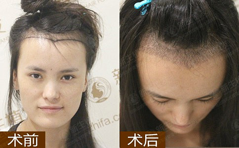 女人脱发的原因