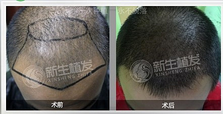 脱发原因是什么，我们该如何预防