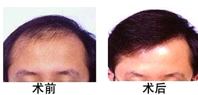 治疗脱发的较好方法