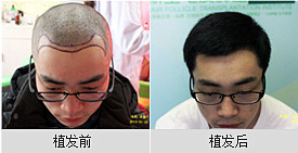 脱发有治疗对策吗