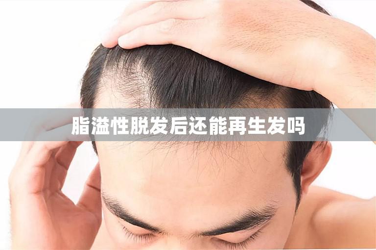 脂溢性脱发后还能再生发吗
