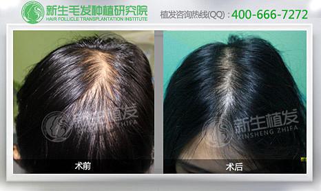 产后妈妈脱发怎么办