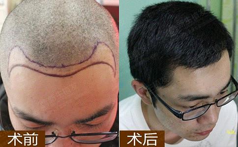 脱发加重的五大征兆，你中招了吗？