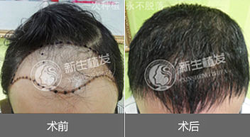 你适合头发种植吗