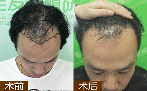 脱发的原因都有哪些呢？