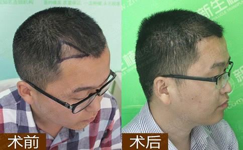 生活中应该如何预防脱发发生？