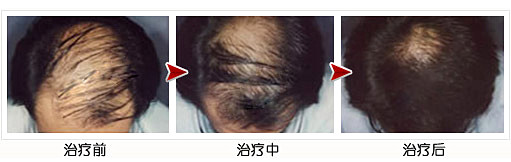 头发稀少怎么让头发变密