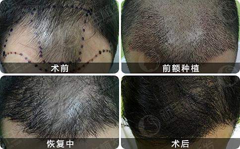 南京脱发治疗哪里好？