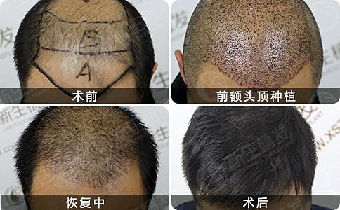 脱发在南京如何治疗好