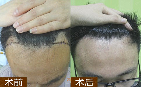 出现严重的脱发要怎么治疗较好