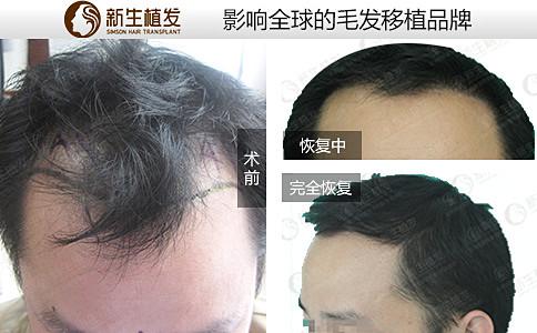 如何预防男性脱发？