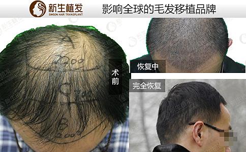 昆明新生脱发治疗