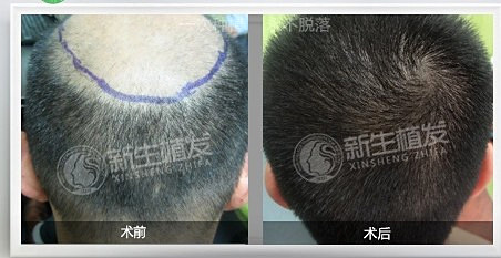 男人脱发治疗具体怎么做
