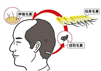 神经性脱发怎么办？