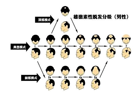 雄性激素与脱发是什么关系 如何治疗脱发