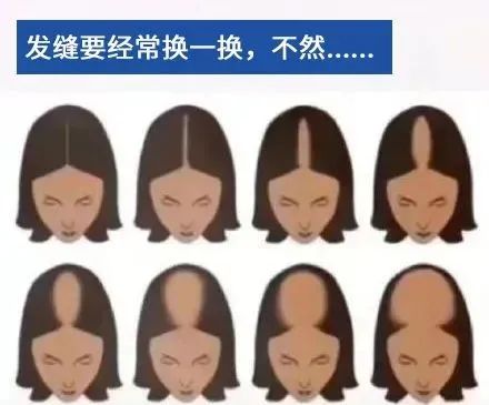 发缝处容易掉发，常换发缝能防脱发吗？