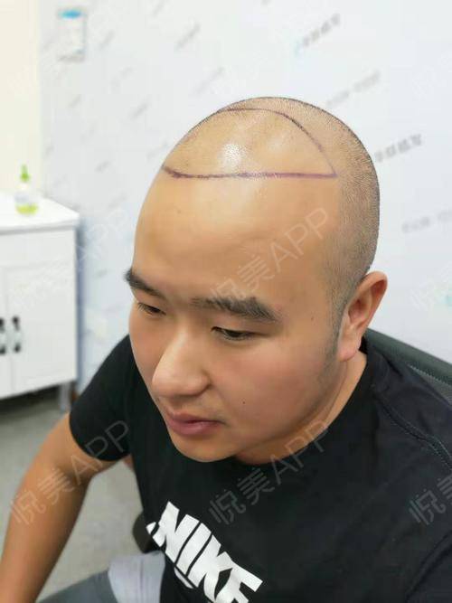 有一天去理发偶然遇到了一个做过植发的朋友