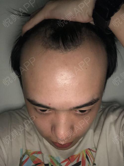 天生的发际线高终于鼓起勇气做植发了