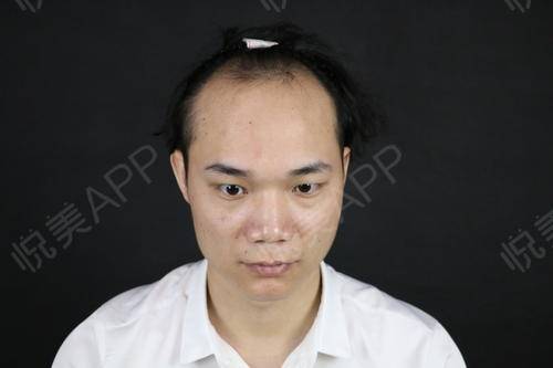 在我20岁之后我发际线就开始后移头发也掉了很多