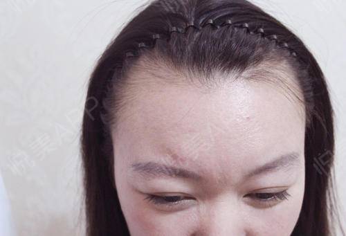 记录我的植发日记，记录生活中的点点滴滴