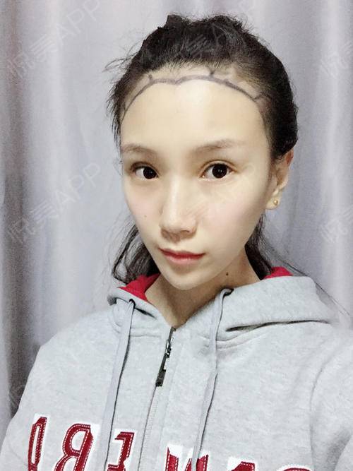 妈妈催着我去做植发担心我以后掉成秃头