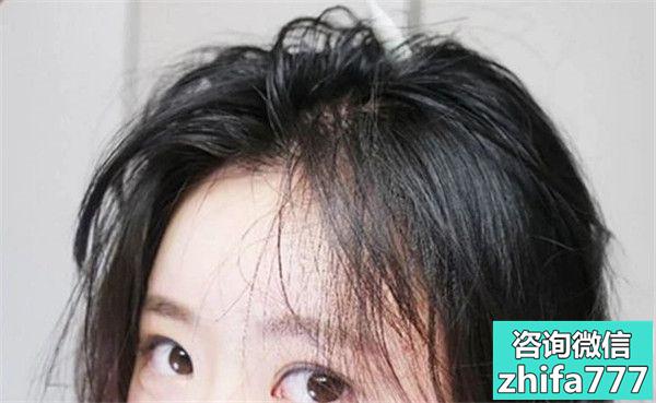 青春期女生脱发都有哪些原因？