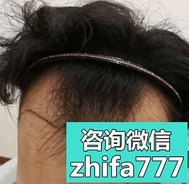 介绍一下我找广州华美代庆成做植发手术的价格和效果