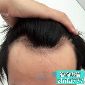 武汉熙朵发际线种植术后效果太棒了