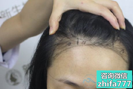 上海新生发际线种植，效果显得脸型很好看