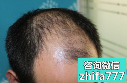 北京丽都发际线种植，效果特别满意
