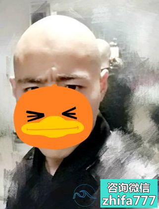 深圳联合丽格秃顶植发，终于有头发了