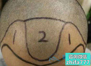 青岛熙朵发际线种植，效果我很满意