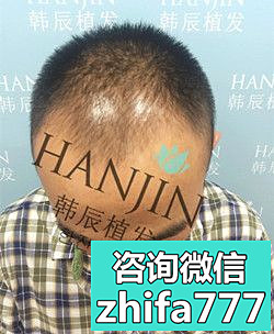 南京韩辰植发真实案例 解决头发稀疏发际线高