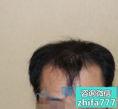 上海碧莲盛发际线种植，让我自信了